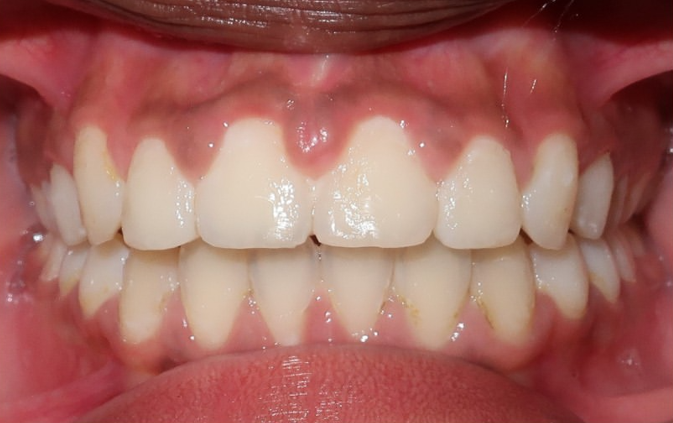 Résultat après traitement aligneurs dentaires - chevauchement corrigé