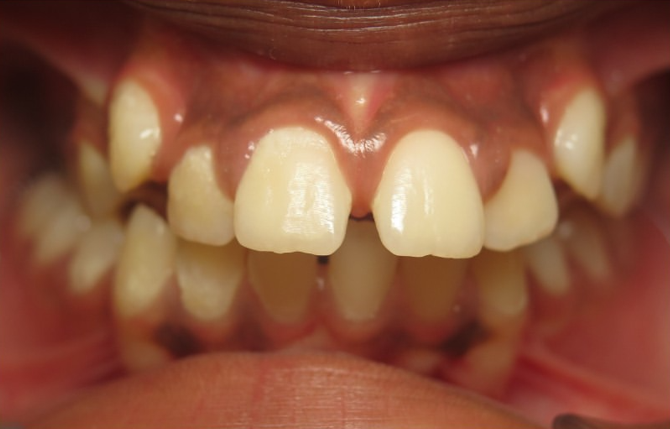 Chevauchement dentaire avant traitement par aligneurs AlignSmile