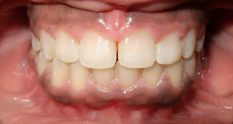 Résultat après traitement aligneurs dentaires - espacement corrigé