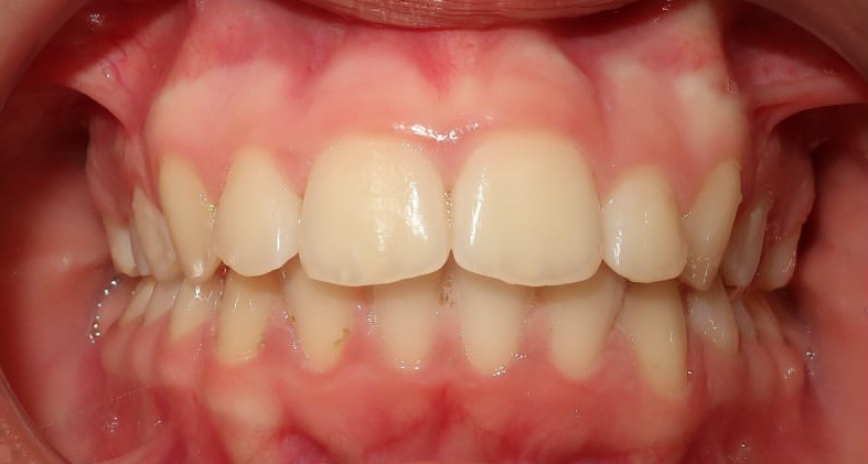 Résultat après traitement aligneurs dentaires - supraclusion corrigée