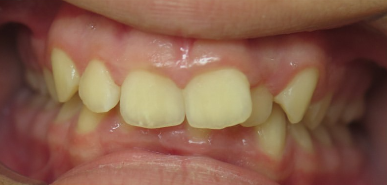 Supraclusion dentaire avant traitement par aligneurs AlignSmile